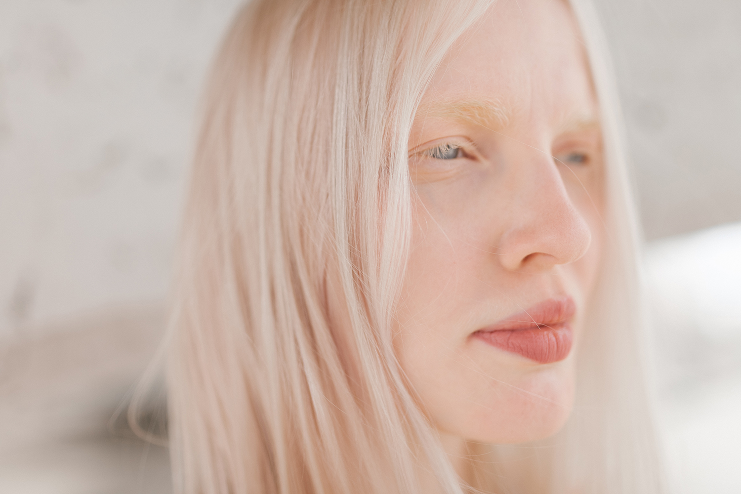 Глазокожный альбинизм