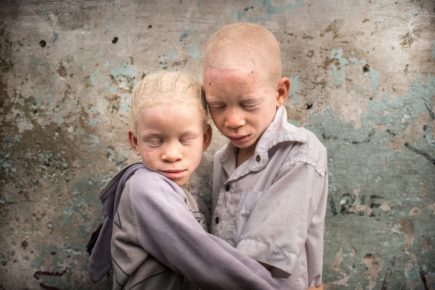 Как люди рождаются альбиносами. Глазокожный альбинизм Тип 3. Дети альбиносы.