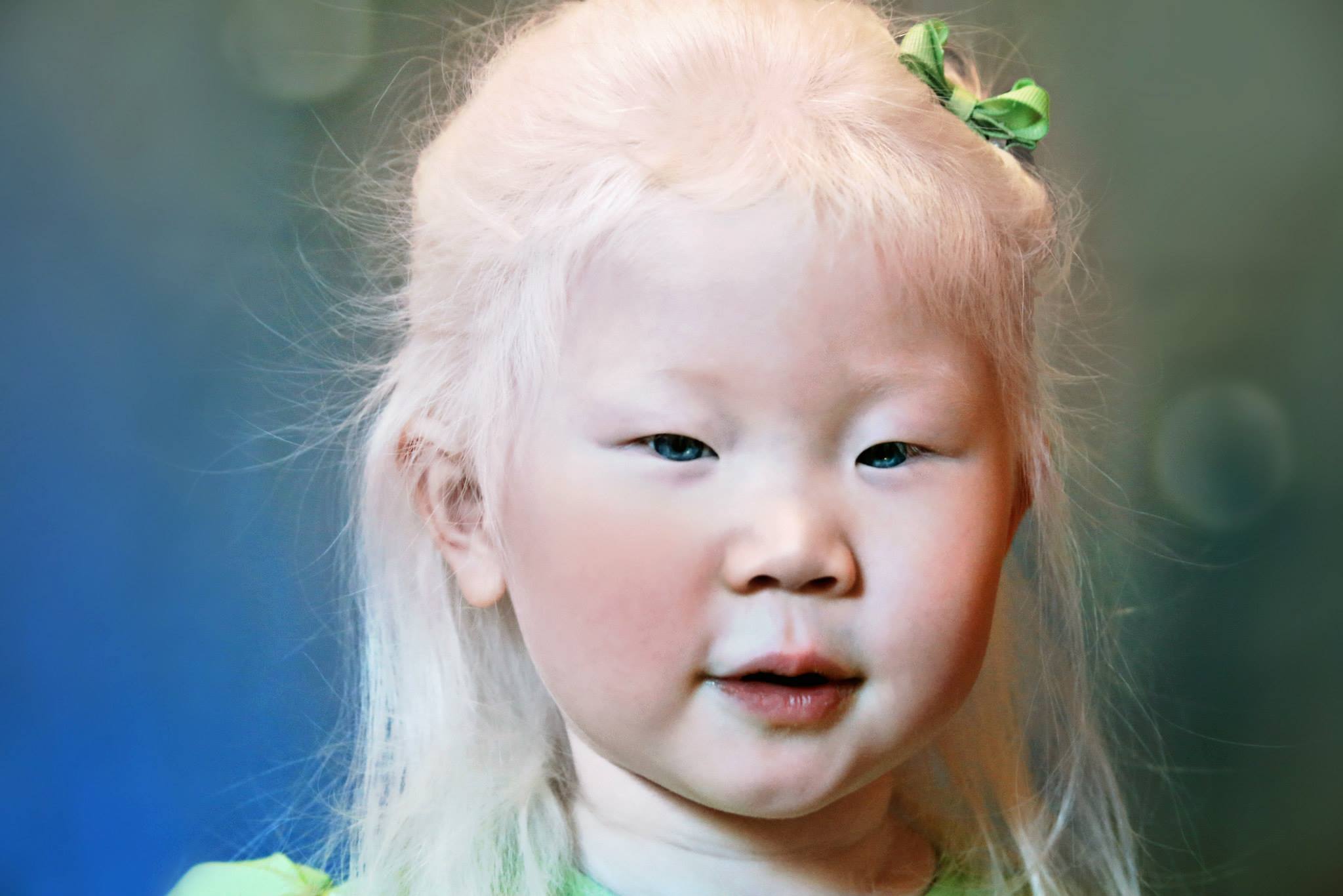 Как люди рождаются альбиносами. Альбинос китаянка Конни Чиу. Альбиносы монголоидной расы. Монгол альбинос. Глазокожный альбинизм.